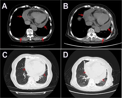 IgG4-related disease with massive pericardial effusion diagnosed clinically using FDG-PETCT: a case report